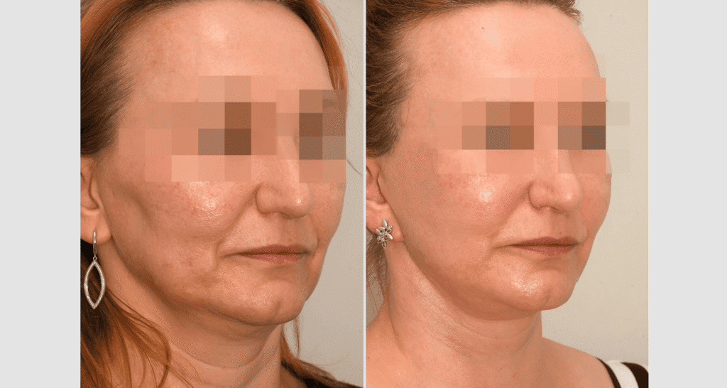 Vorher/Nachher Ergebnis: Facelift