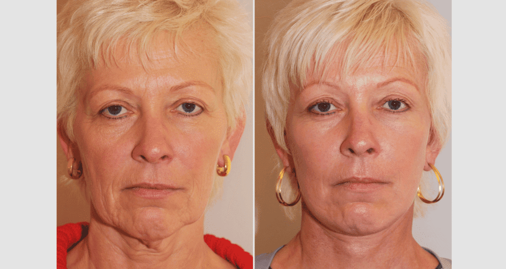 Vorher/Nachher Ergebnis: Facelift