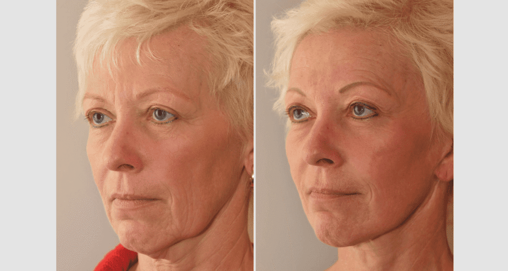 Vorher/Nachher Ergebnis: Facelift