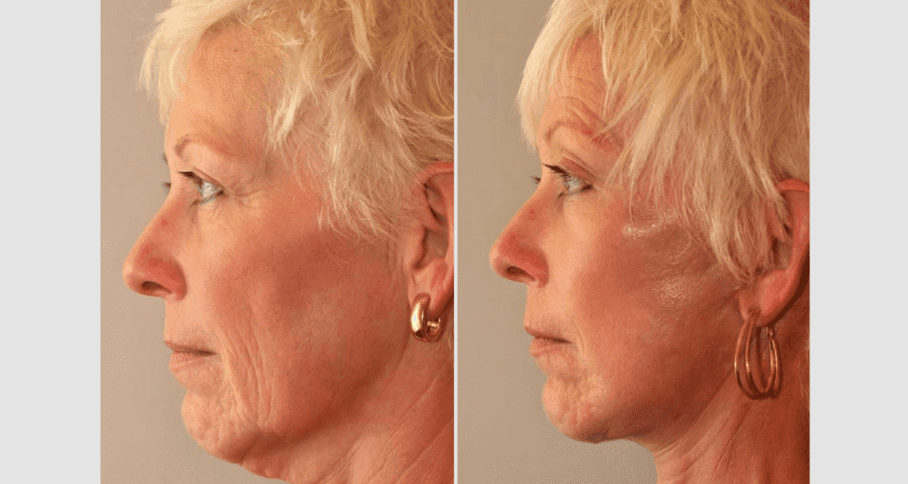 Vorher/Nachher Ergebnis: Facelift