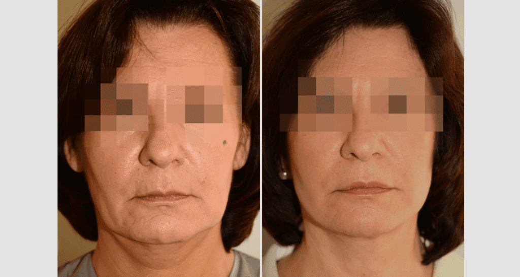 Vorher/Nachher Ergebnis: Facelift