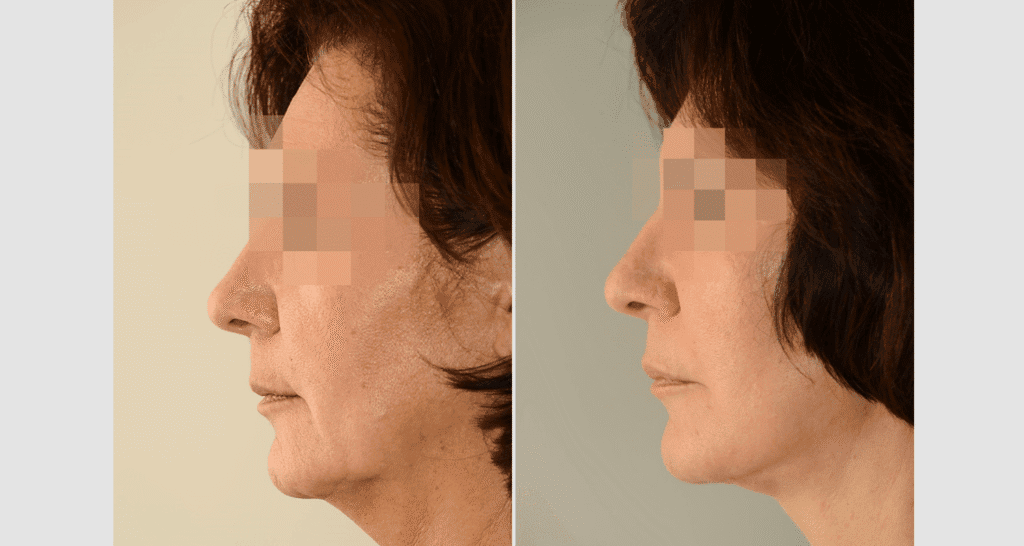 Vorher/Nachher Ergebnis: Facelift