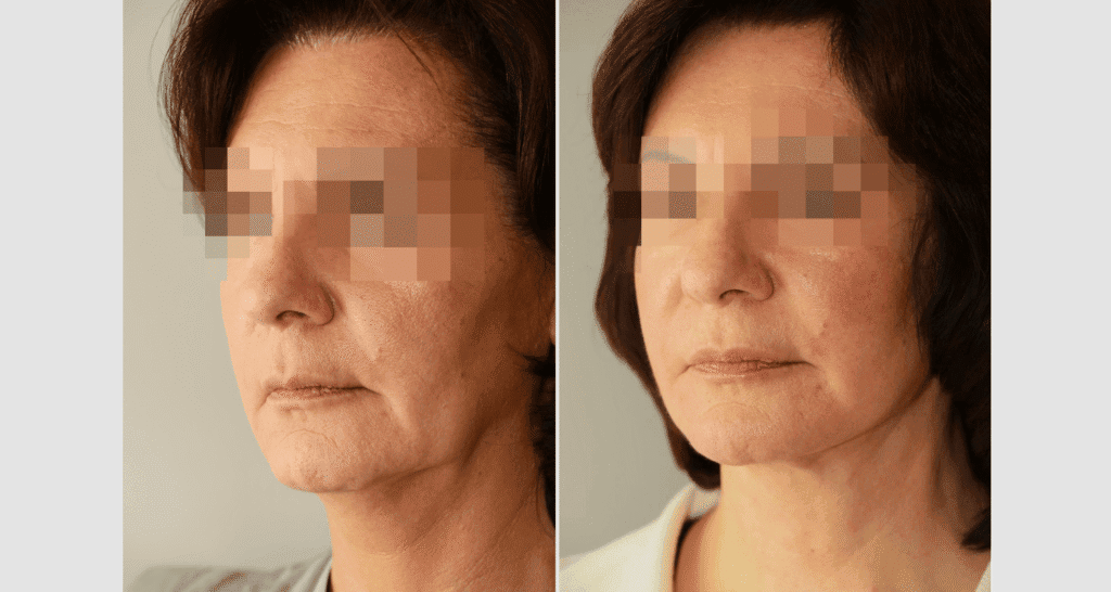 Vorher/Nachher Ergebnis: Facelift