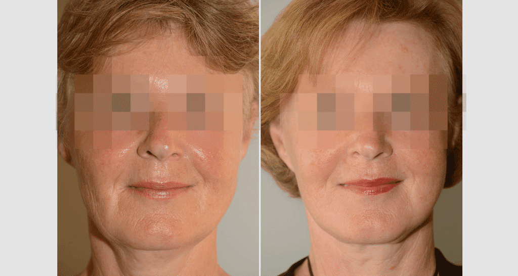 Vorher/Nachher Ergebnis: Facelift