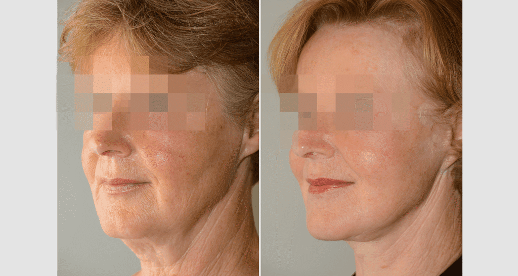 Vorher/Nachher Ergebnis: Facelift