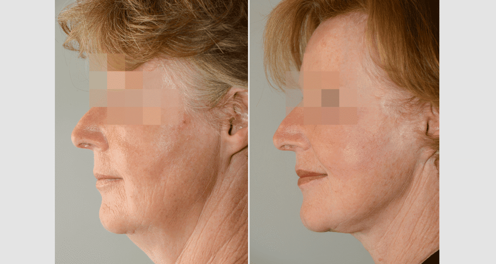 Vorher/Nachher Ergebnis: Facelift