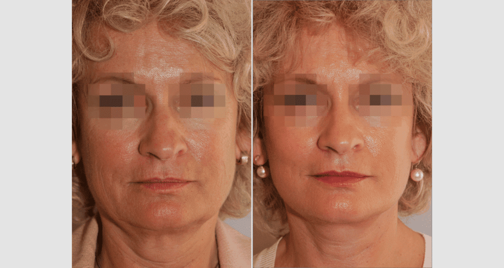 Vorher/Nachher Ergebnis: Facelift