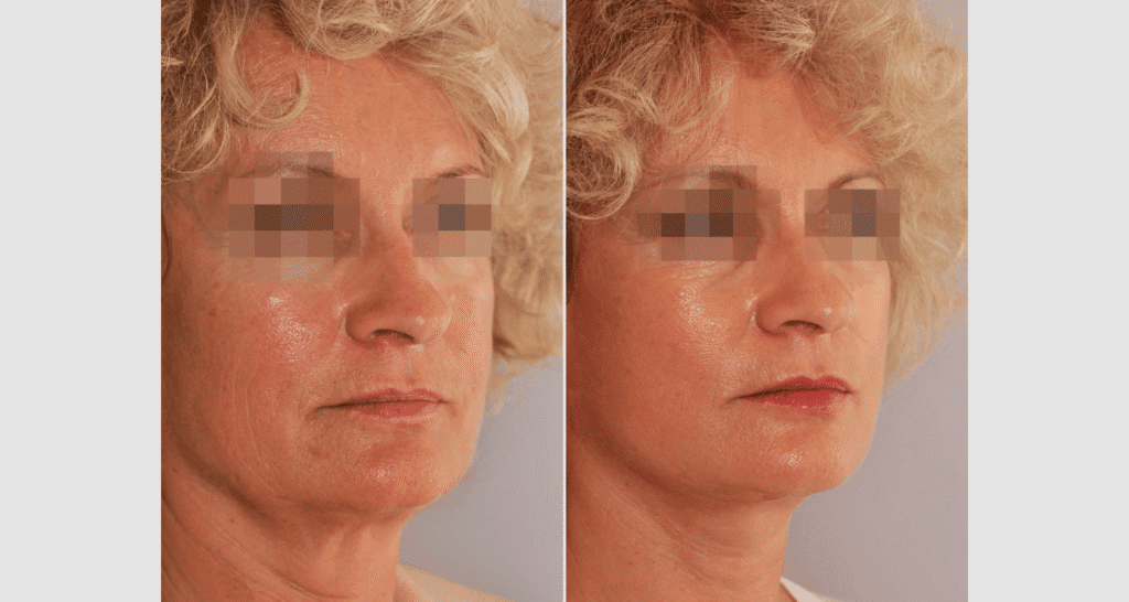 Vorher/Nachher Ergebnis: Facelift