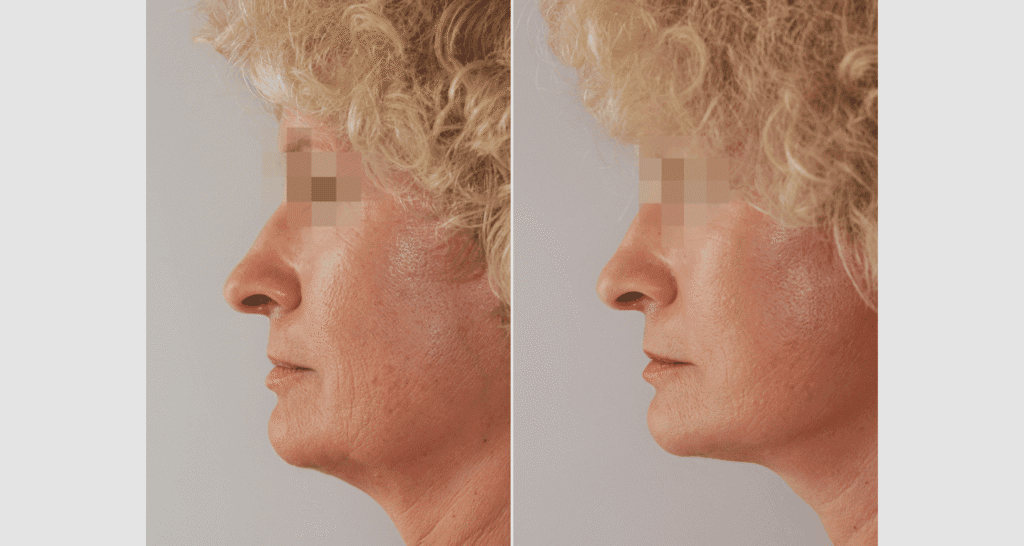 Vorher/Nachher Ergebnis: Facelift