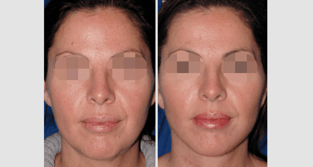 Vorher/Nachher Ergebnis: Facelift
