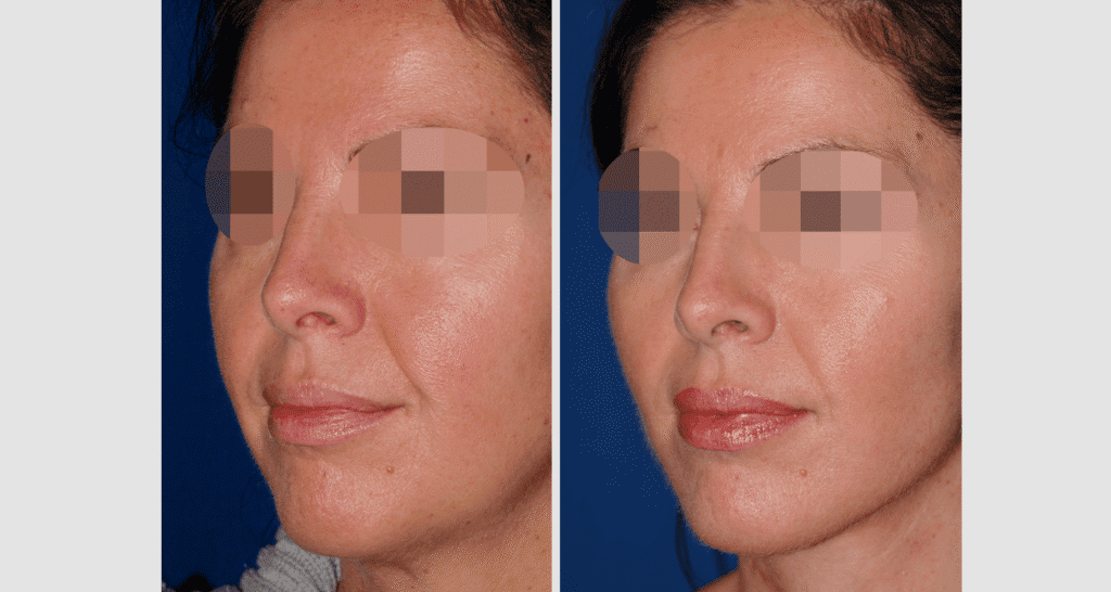 Vorher/Nachher Ergebnis: Facelift