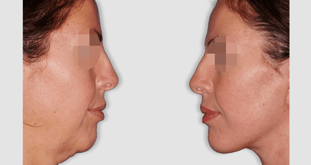 Vorher/Nachher Ergebnis: Facelift