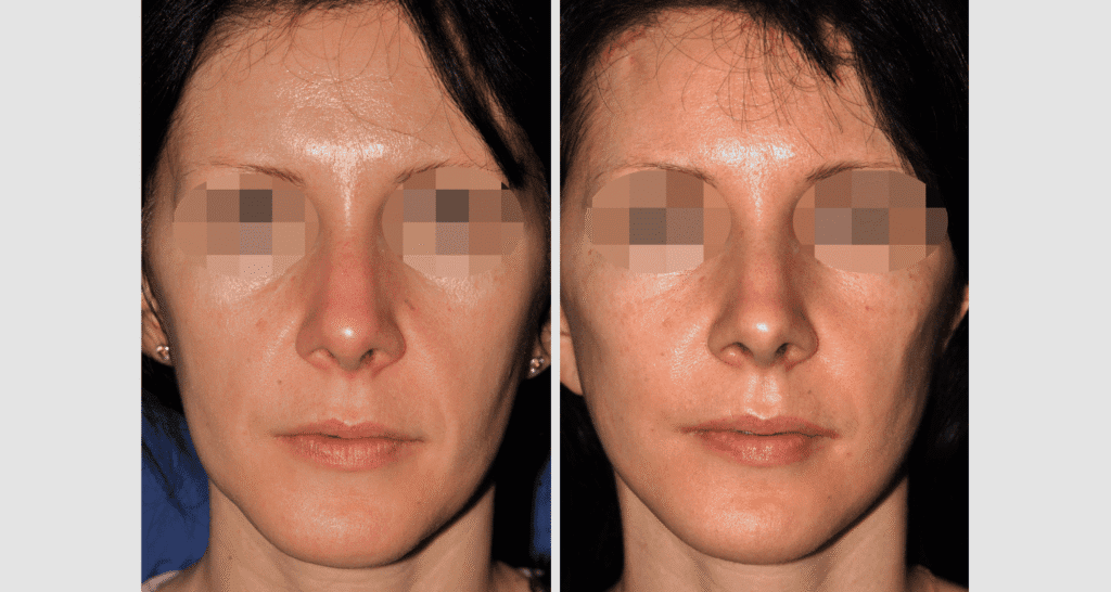 Vorher/Nachher Ergebnis: Facelift