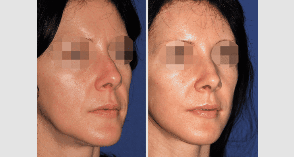 Vorher/Nachher Ergebnis: Facelift