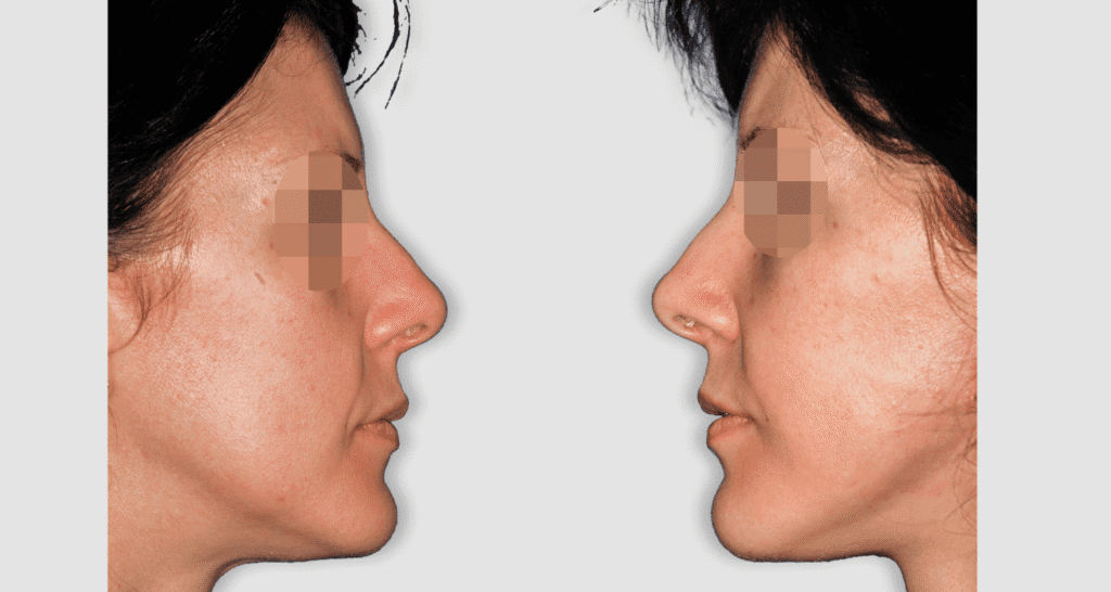 Vorher/Nachher Ergebnis: Facelift