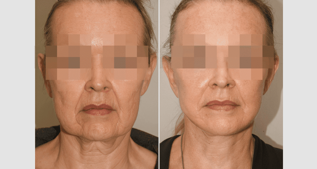 Vorher/Nachher Ergebnis: Facelift