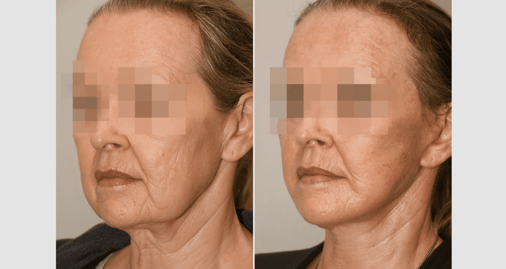 Vorher/Nachher Ergebnis: Facelift