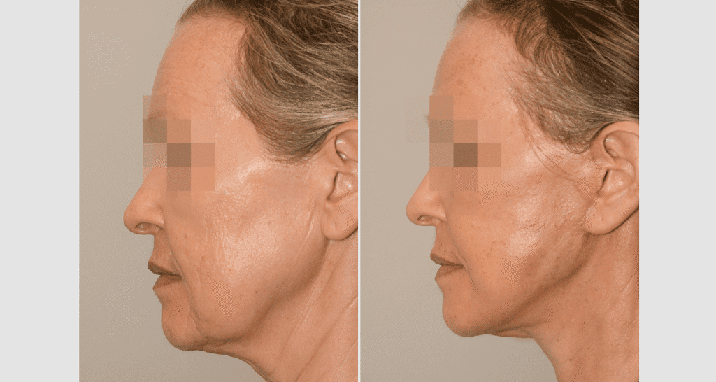 Vorher/Nachher Ergebnis: Facelift