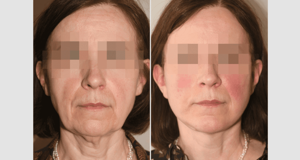 Vorher/Nachher Ergebnis: Facelift