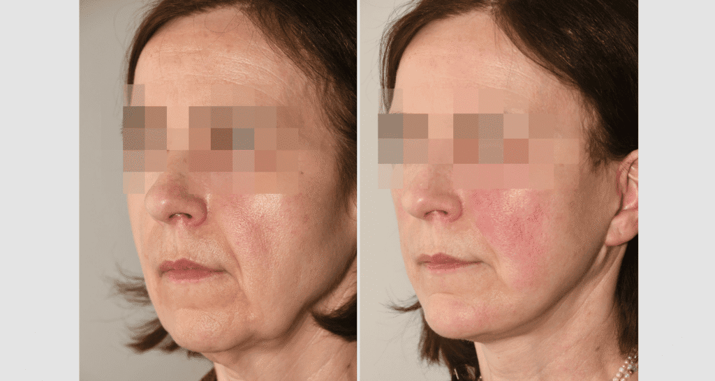 Vorher/Nachher Ergebnis: Facelift