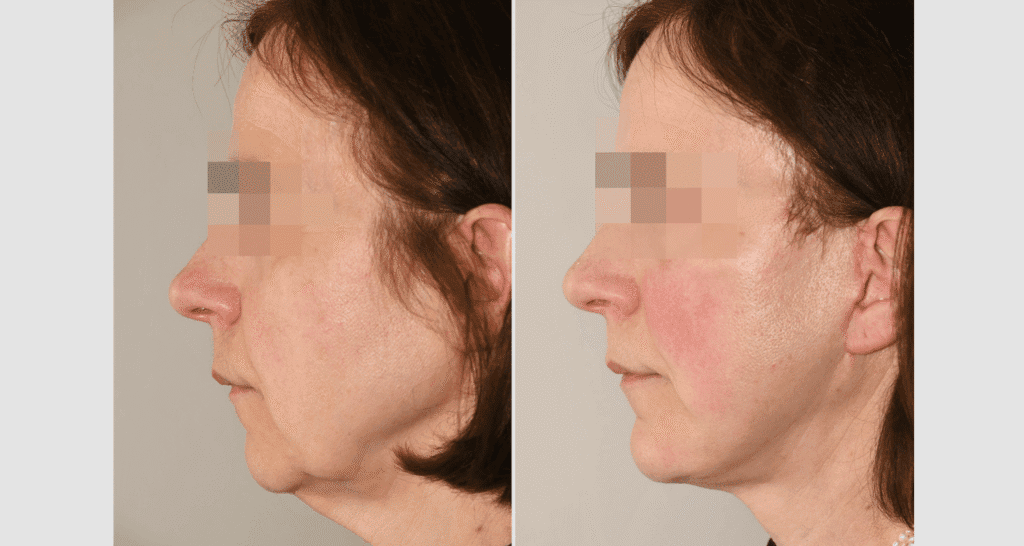 Vorher/Nachher Ergebnis: Facelift