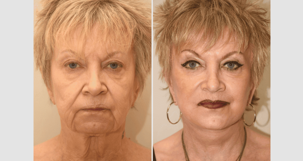 Vorher/Nachher Ergebnis: Facelift