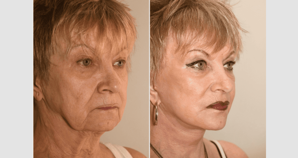 Vorher/Nachher Ergebnis: Facelift