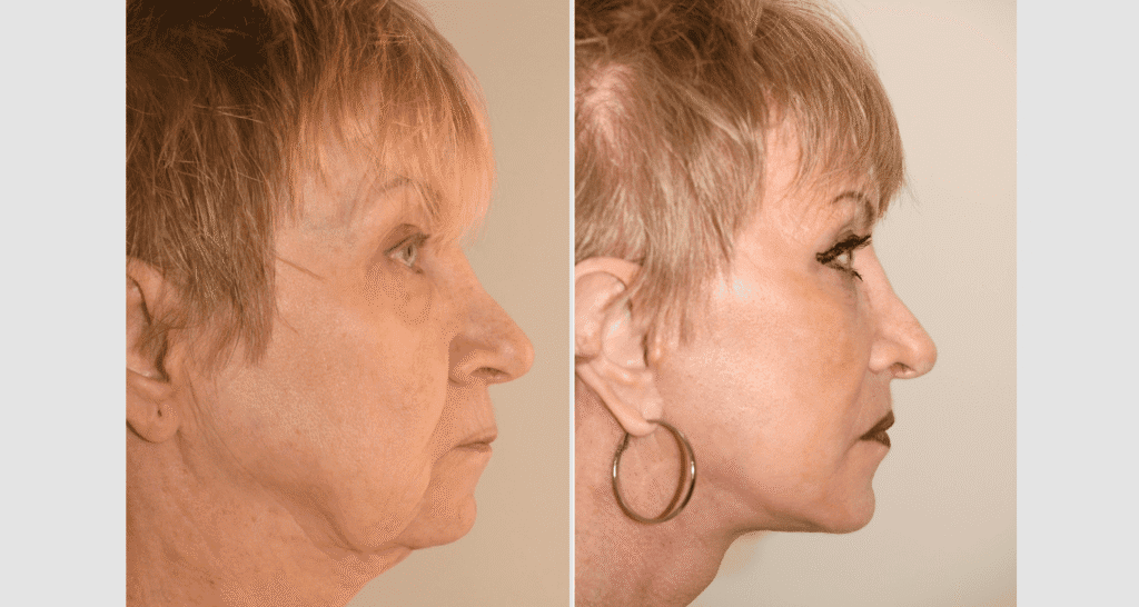 Vorher/Nachher Ergebnis: Facelift