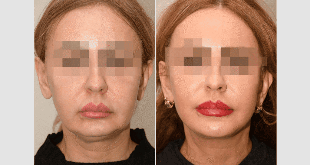 Vorher/Nachher Ergebnis: Facelift