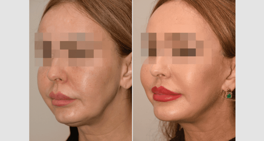 Vorher/Nachher Ergebnis: Facelift