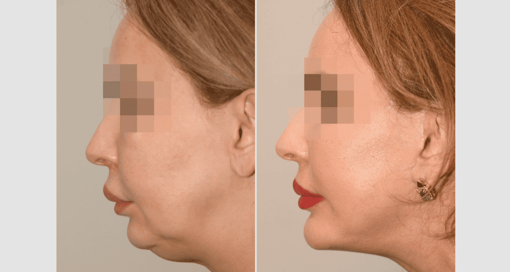 Vorher/Nachher Ergebnis: Facelift
