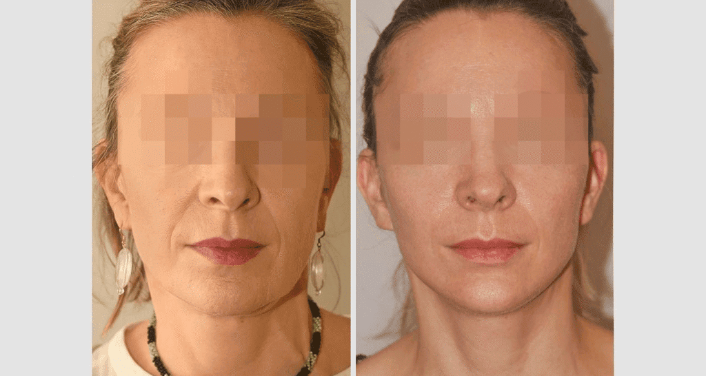 Vorher/Nachher Ergebnis: Facelift