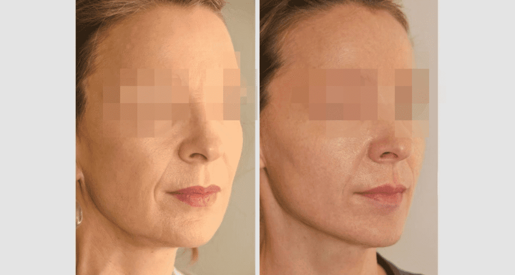 Vorher/Nachher Ergebnis: Facelift