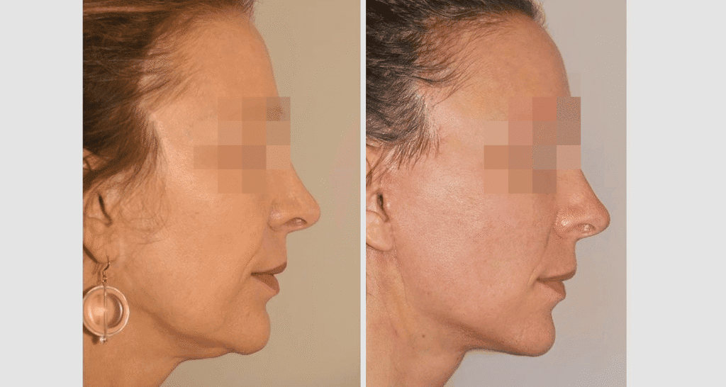 Vorher/Nachher Ergebnis: Facelift