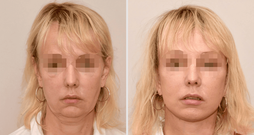 Vorher/Nachher Ergebnis: Facelift