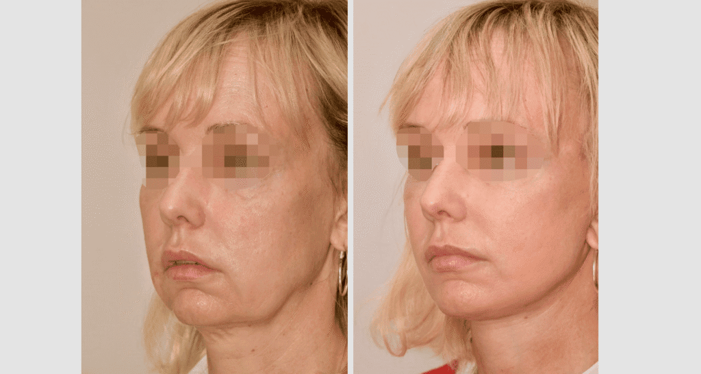 Vorher/Nachher Ergebnis: Facelift
