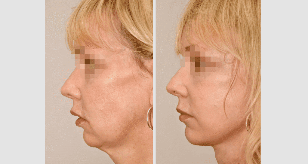 Vorher/Nachher Ergebnis: Facelift