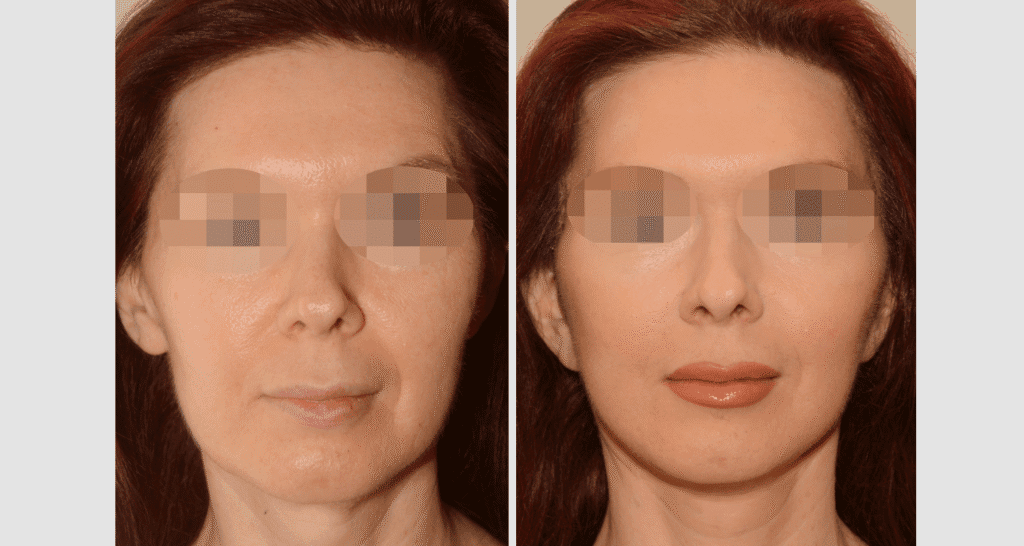 Vorher/Nachher Ergebnis: Facelift