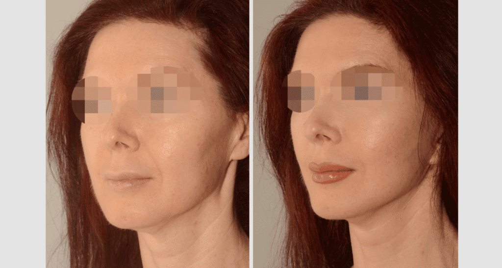 Vorher/Nachher Ergebnis: Facelift
