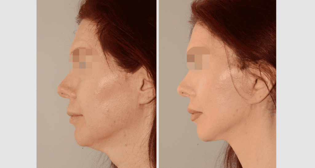 Vorher/Nachher Ergebnis: Facelift