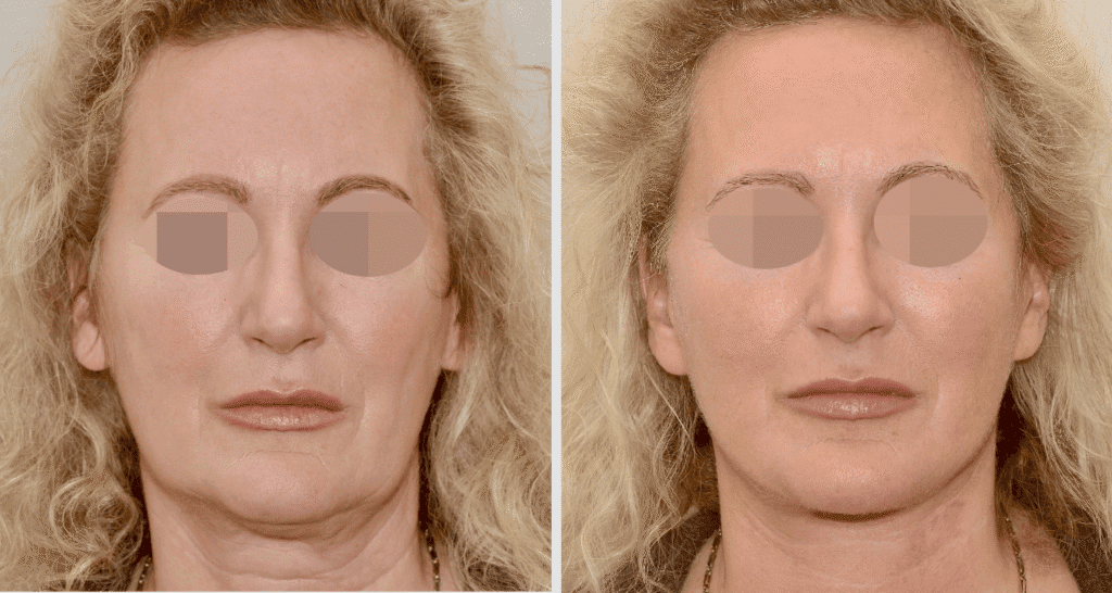 Vorher/Nachher Ergebnis: Facelift
