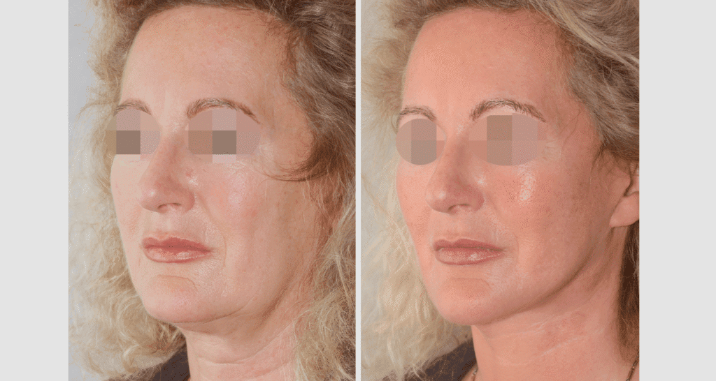 Vorher/Nachher Ergebnis: Facelift
