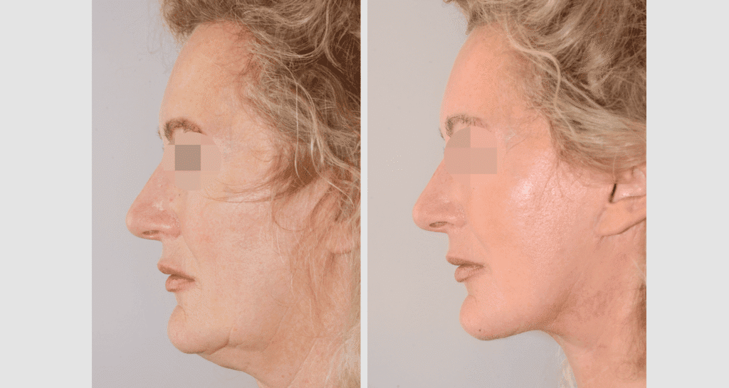 Vorher/Nachher Ergebnis: Facelift
