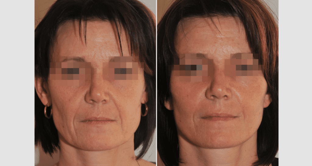 Vorher/Nachher Ergebnis: Facelift