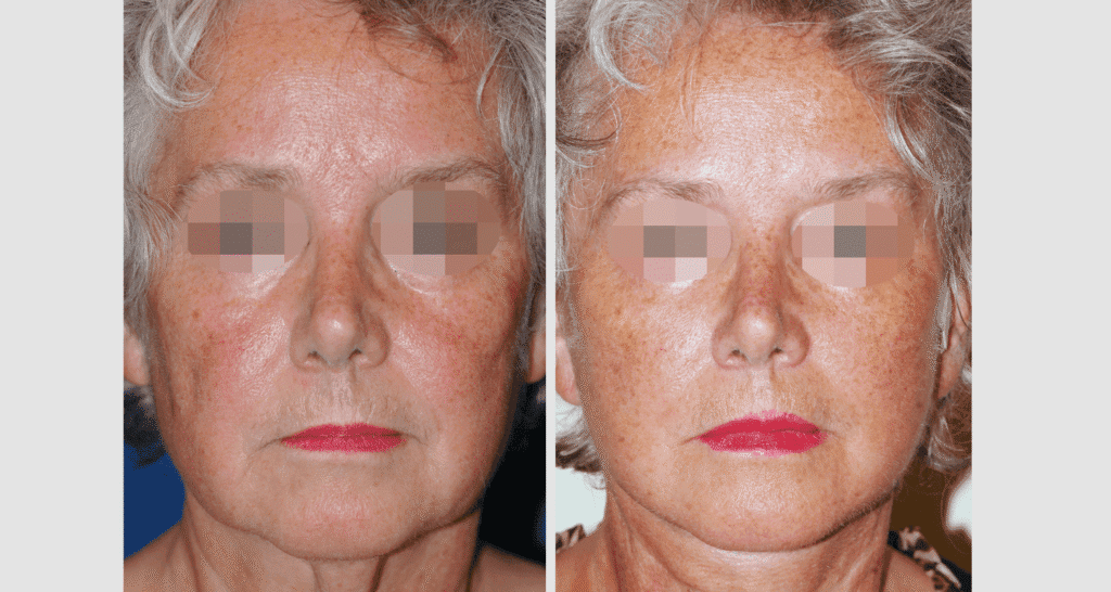 Vorher/Nachher Ergebnis: Facelift