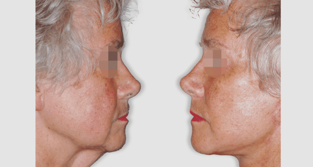 Vorher/Nachher Ergebnis: Facelift