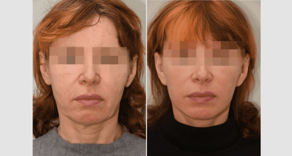 Vorher/Nachher Ergebnis: Facelift