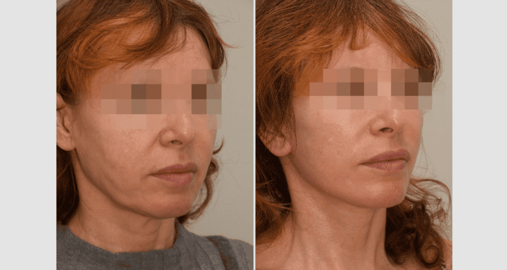 Vorher/Nachher Ergebnis: Facelift