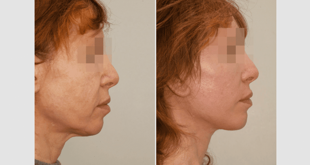 Vorher/Nachher Ergebnis: Facelift