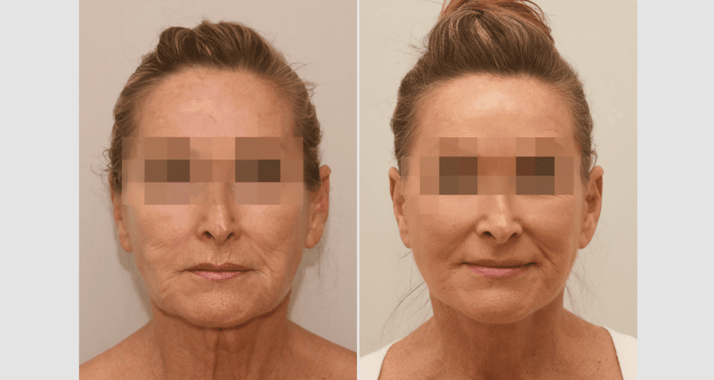 Vorher/Nachher Ergebnis: Facelift